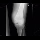 Chondromatosis of knee joint, effusion, fracture of femur, osteosynthesis: X-ray - Plain radiograph